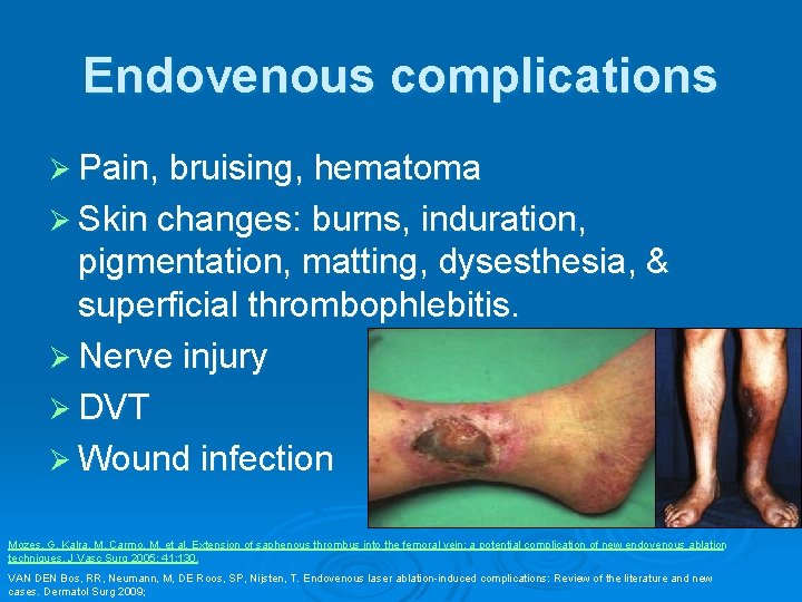 Endovenous complications Ø Pain, bruising, hematoma Ø Skin changes: burns, induration, pigmentation, matting, dysesthesia,