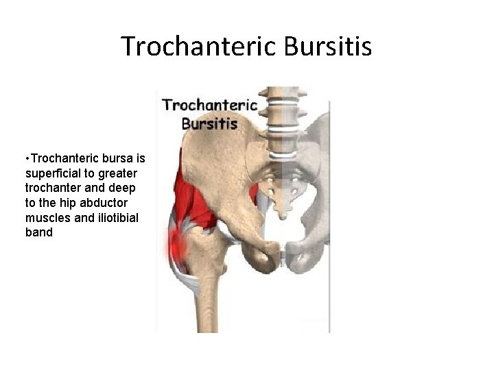 Trochanteric Bursitis • Trochanteric bursa is superficial to greater trochanter and deep to the