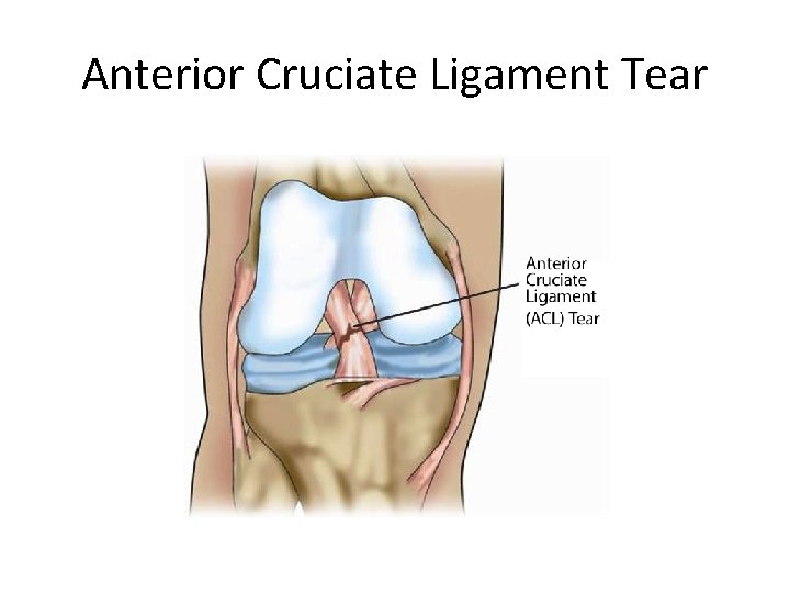 Anterior Cruciate Ligament Tear 