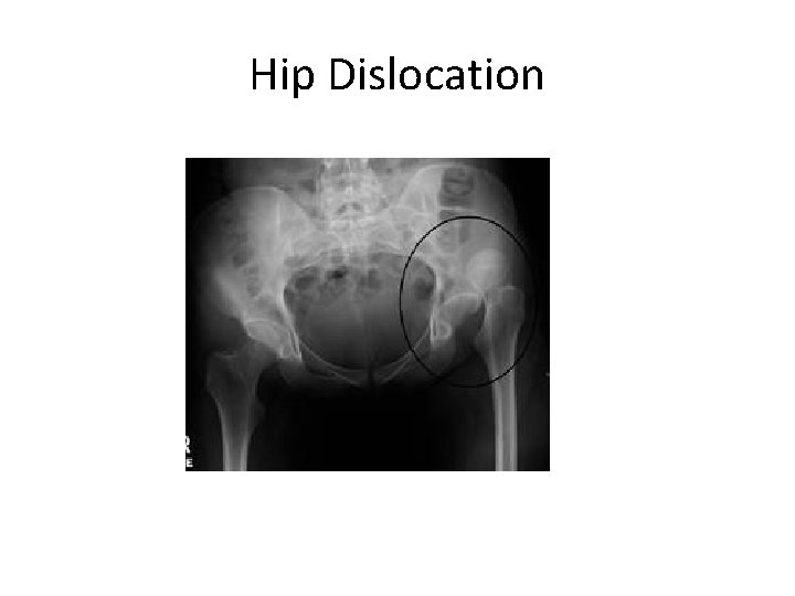 Hip Dislocation 