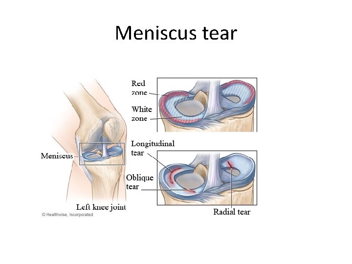 Meniscus tear 