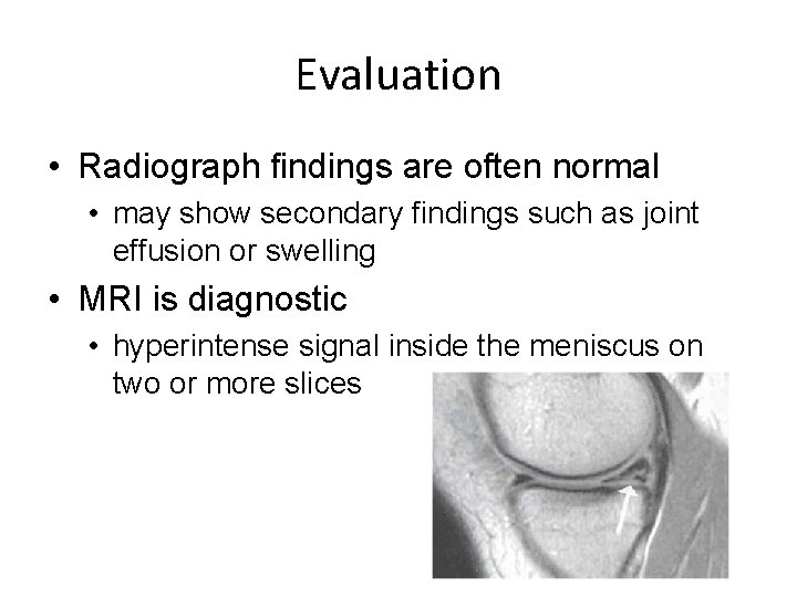Evaluation • Radiograph findings are often normal • may show secondary findings such as