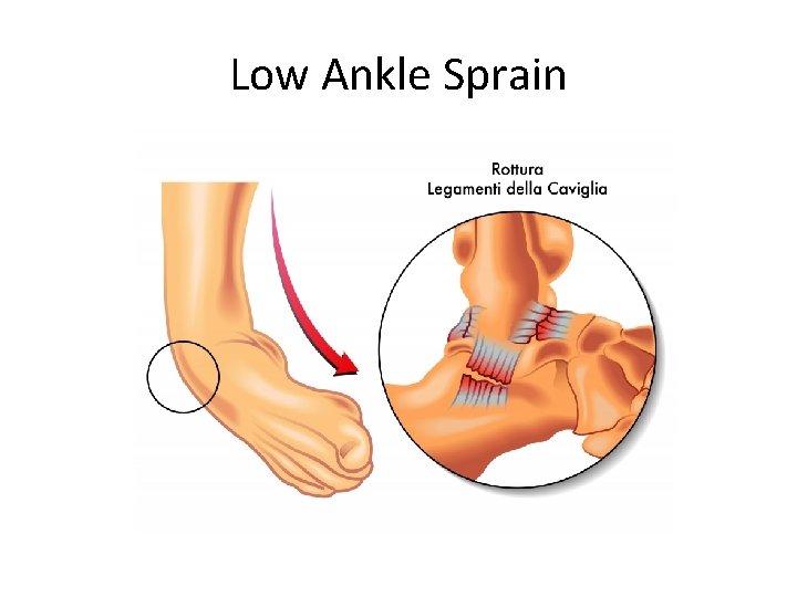 Low Ankle Sprain 