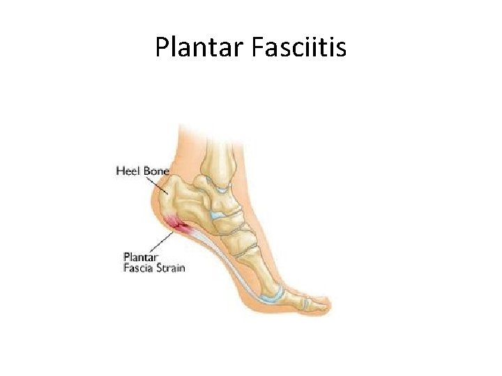 Plantar Fasciitis 