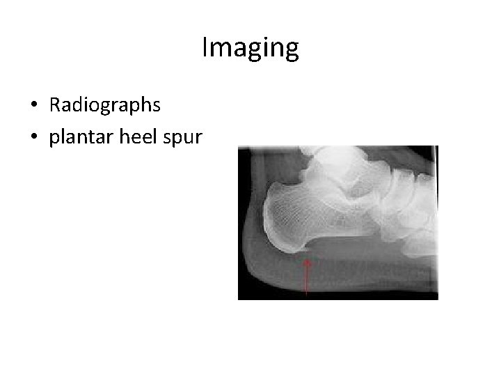 Imaging • Radiographs • plantar heel spur 