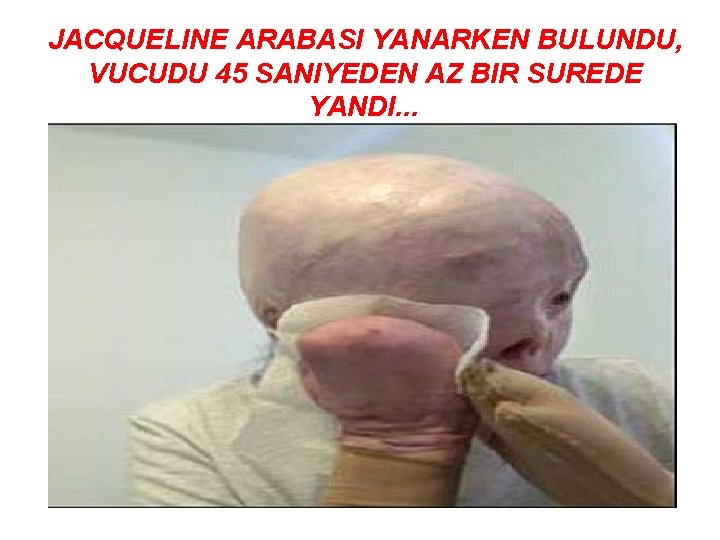 JACQUELINE ARABASI YANARKEN BULUNDU, VUCUDU 45 SANIYEDEN AZ BIR SUREDE YANDI. . . 