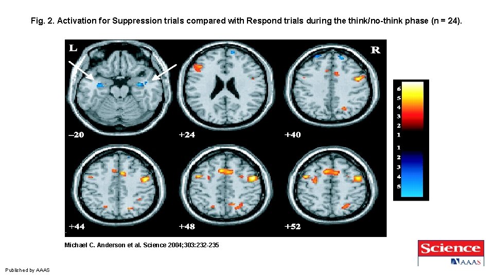 Fig. 2. Activation for Suppression trials compared with Respond trials during the think/no-think phase