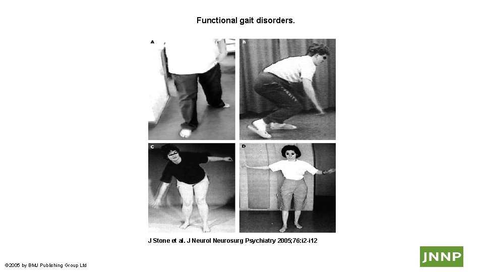  Functional gait disorders. J Stone et al. J Neurol Neurosurg Psychiatry 2005; 76: i