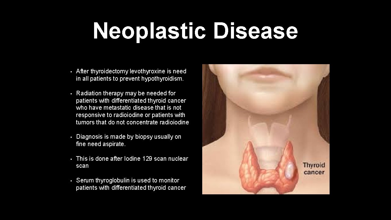 Neoplastic Disease • After thyroidectomy levothyroxine is need in all patients to prevent hypothyroidism.