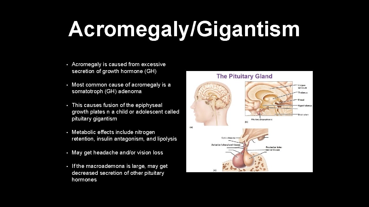 Acromegaly/Gigantism • Acromegaly is caused from excessive secretion of growth hormone (GH) • Most