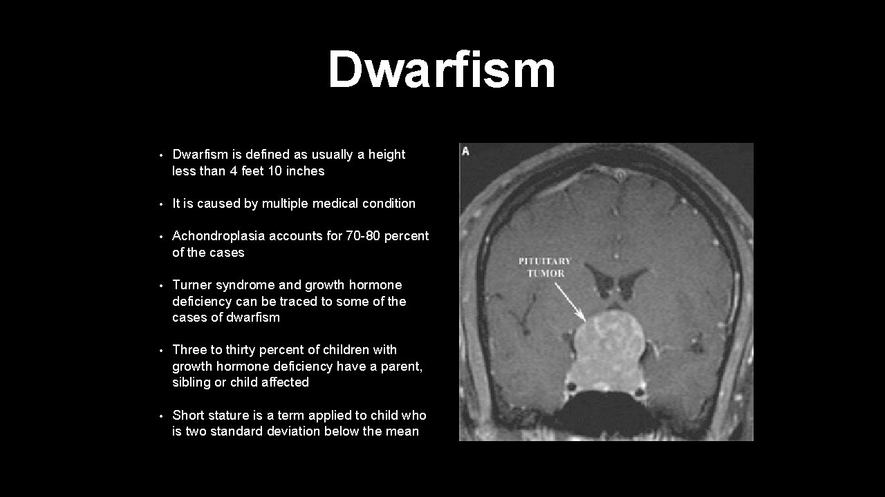 Dwarfism • Dwarfism is defined as usually a height less than 4 feet 10