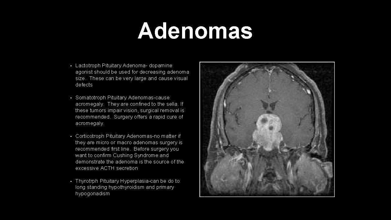 Adenomas • Lactotroph Pituitary Adenoma- dopamine agonist should be used for decreasing adenoma size.