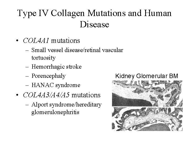 Type IV Collagen Mutations and Human Disease • COL 4 A 1 mutations –