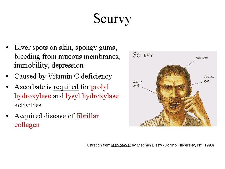 Scurvy • Liver spots on skin, spongy gums, bleeding from mucous membranes, immobility, depression