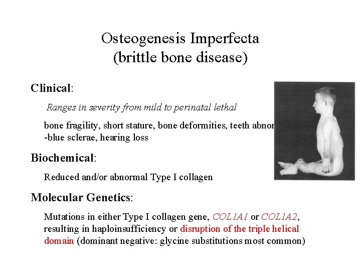 Osteogenesis Imperfecta (brittle bone disease) Clinical: Ranges in severity from mild to perinatal lethal