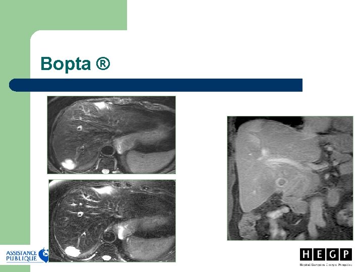 Bopta ® Bopta ®