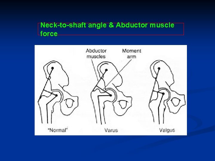 Neck-to-shaft angle & Abductor muscle force 