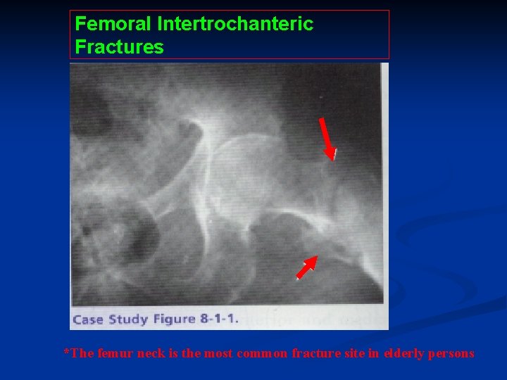 Femoral Intertrochanteric Fractures *The femur neck is the most common fracture site in elderly