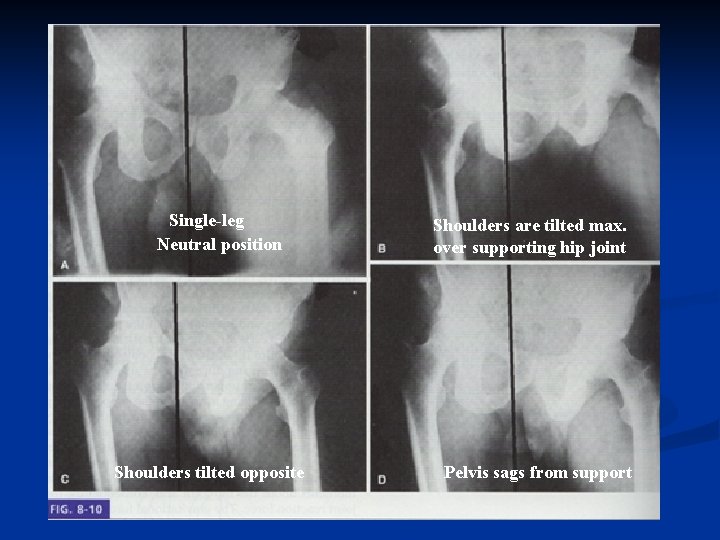 Single-leg Neutral position Shoulders tilted opposite Shoulders are tilted max. over supporting hip joint