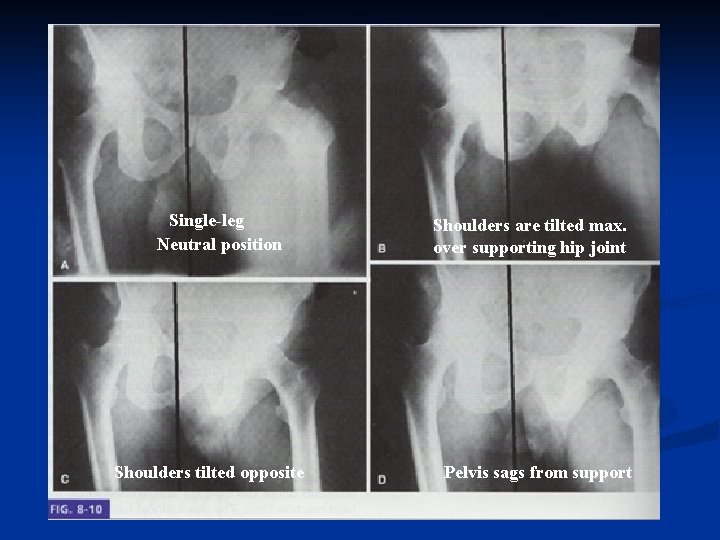 Single-leg Neutral position Shoulders tilted opposite Shoulders are tilted max. over supporting hip joint