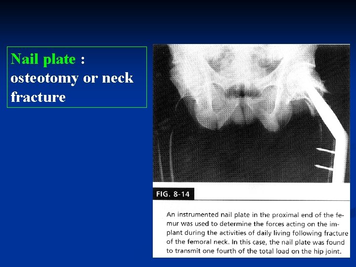 Nail plate : osteotomy or neck fracture 