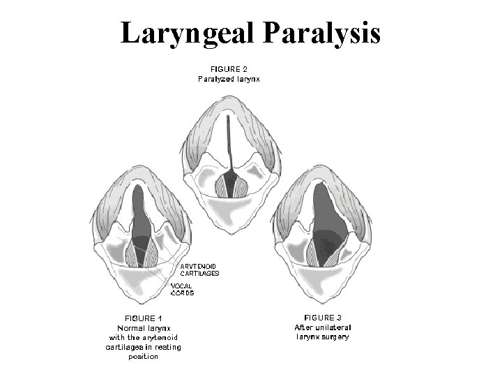 Laryngeal Paralysis 