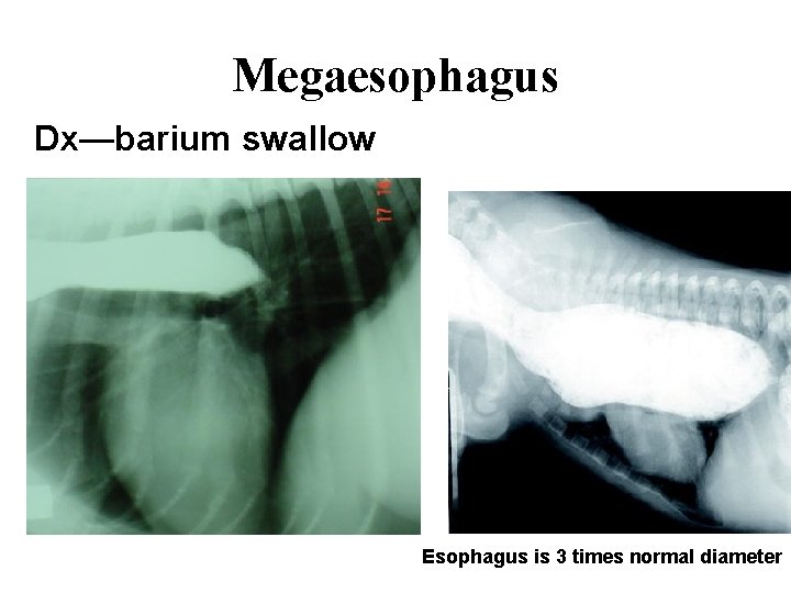 Megaesophagus Dx—barium swallow Esophagus is 3 times normal diameter 