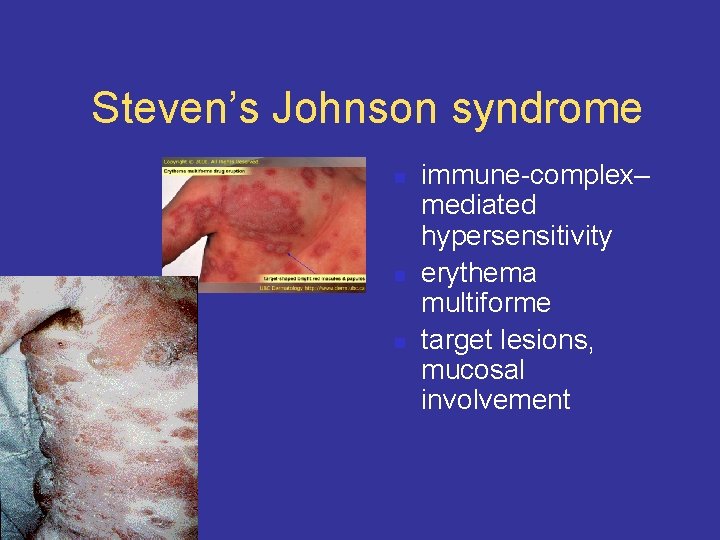 Steven’s Johnson syndrome n n n immune-complex– mediated hypersensitivity erythema multiforme target lesions, mucosal