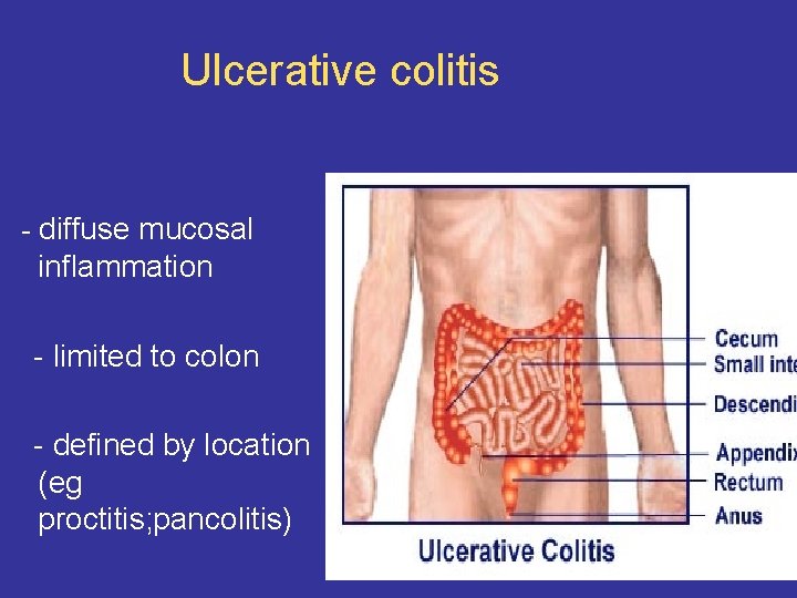 Ulcerative colitis - diffuse mucosal inflammation - limited to colon - defined by location