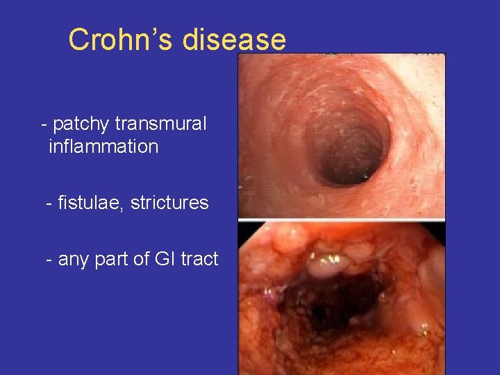 Crohn’s disease - patchy transmural inflammation - fistulae, strictures - any part of GI