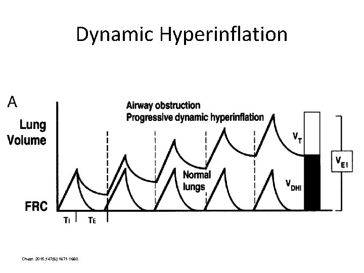 Dynamic Hyperinflation Chest. 2015; 147(6): 1671 -1680. 