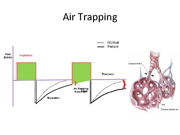 Air Trapping 