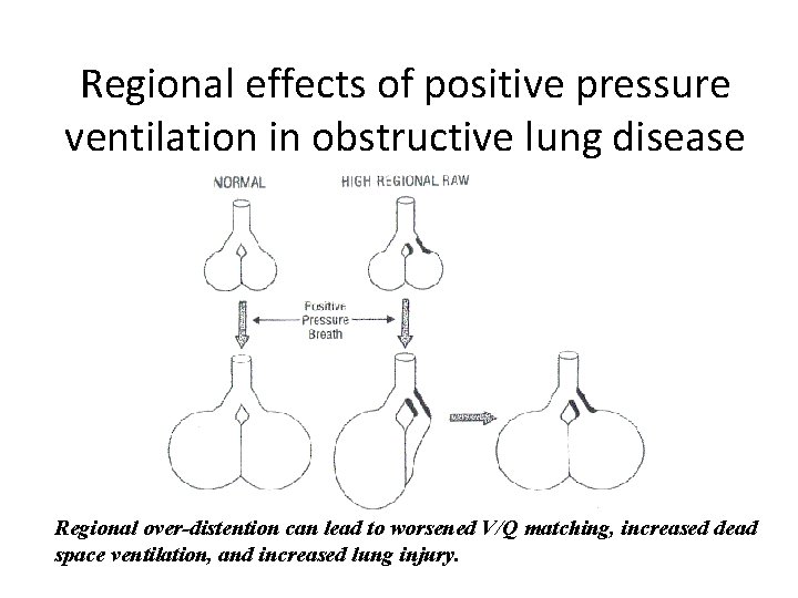 Regional effects of positive pressure ventilation in obstructive lung disease Regional over-distention can lead