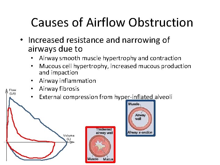 Causes of Airflow Obstruction • Increased resistance and narrowing of airways due to •