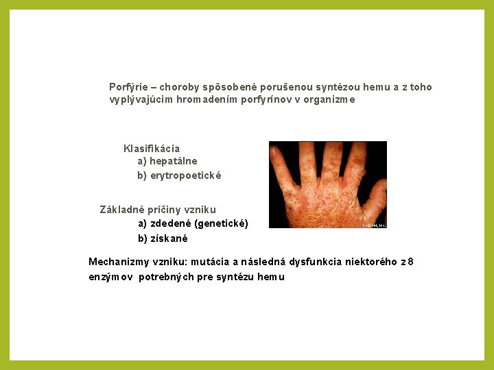 Porfýrie – choroby spôsobené porušenou syntézou hemu a z toho vyplývajúcim hromadením porfyrínov v