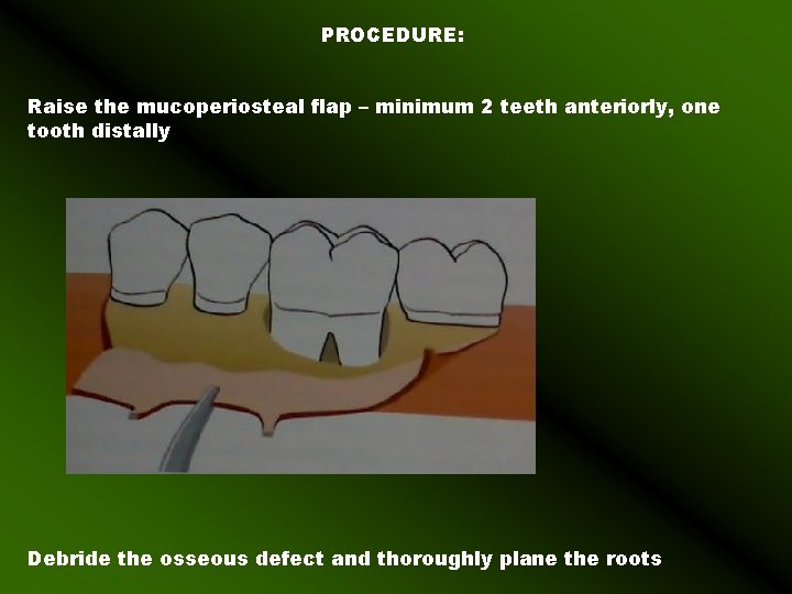 PROCEDURE: Raise the mucoperiosteal flap – minimum 2 teeth anteriorly, one tooth distally Debride