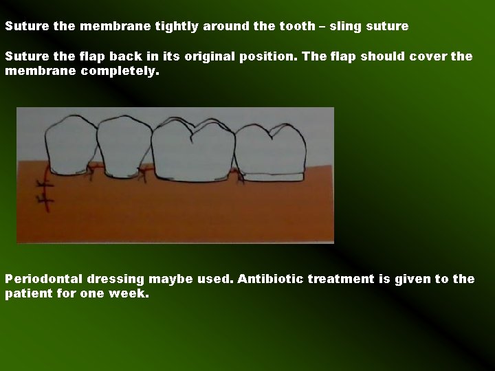 Suture the membrane tightly around the tooth – sling suture Suture the flap back