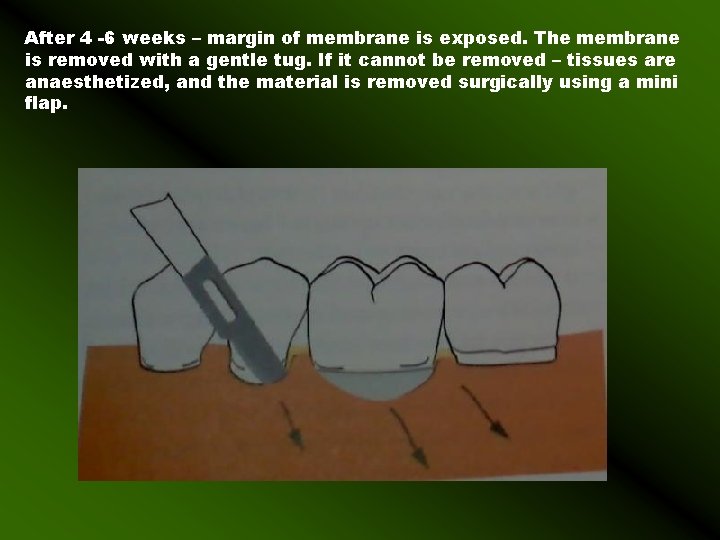After 4 -6 weeks – margin of membrane is exposed. The membrane is removed