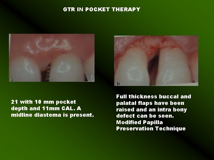 GTR IN POCKET THERAPY 21 with 10 mm pocket depth and 11 mm CAL.