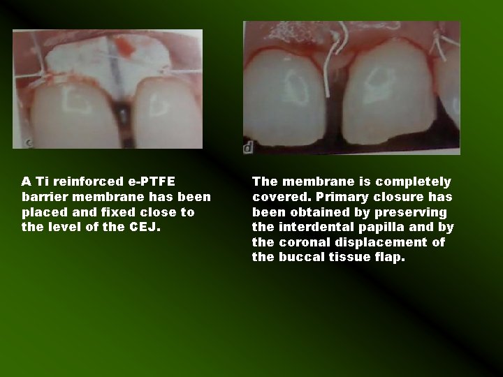 A Ti reinforced e-PTFE barrier membrane has been placed and fixed close to the