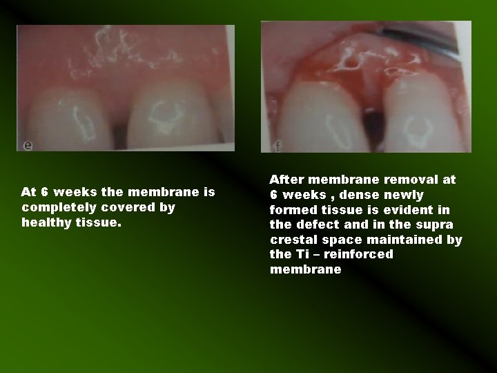 At 6 weeks the membrane is completely covered by healthy tissue. After membrane removal