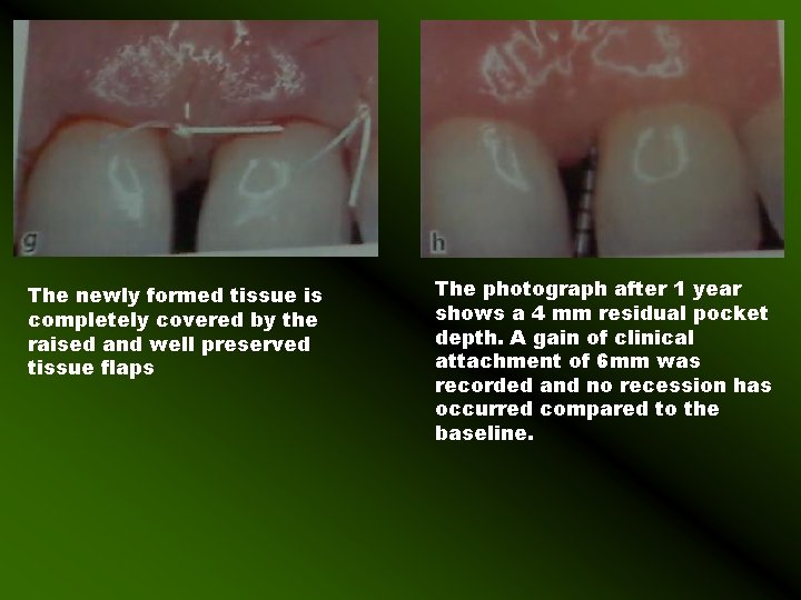 The newly formed tissue is completely covered by the raised and well preserved tissue