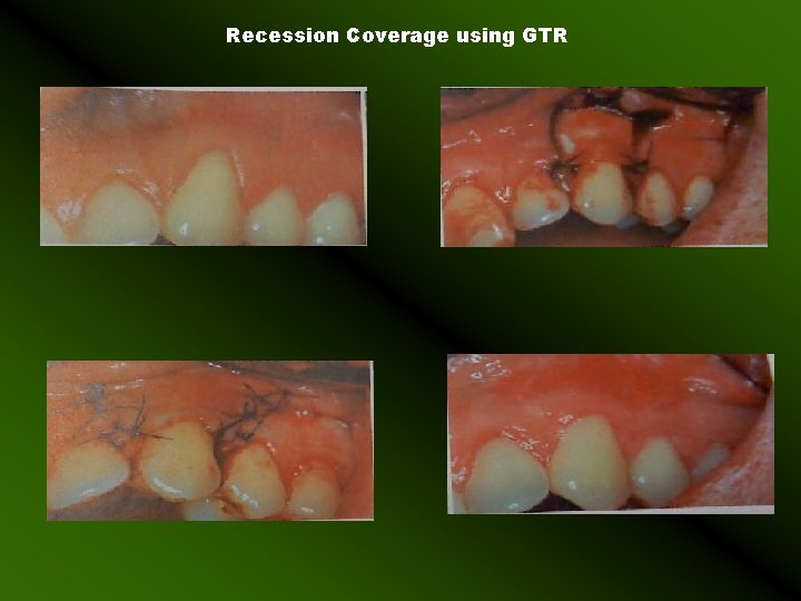 Recession Coverage using GTR 