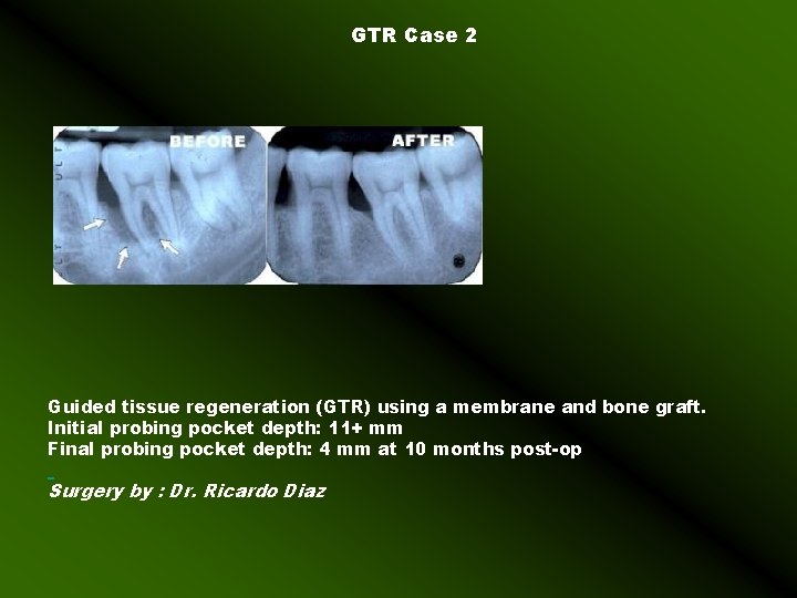 GTR Case 2 Guided tissue regeneration (GTR) using a membrane and bone graft. Initial