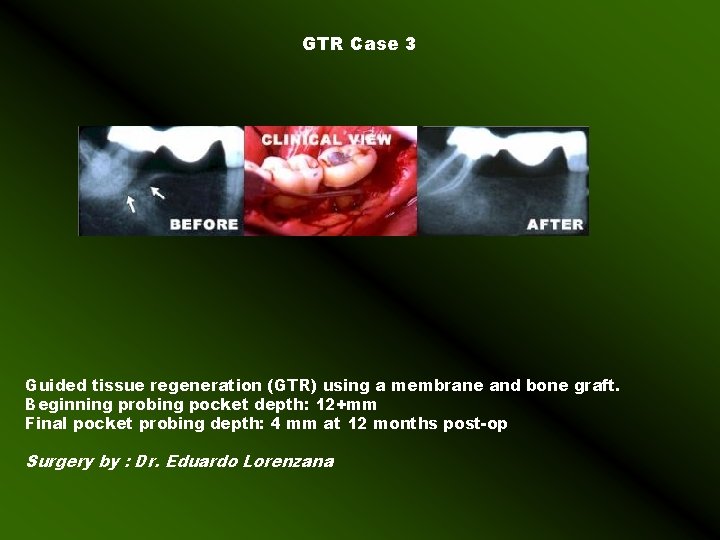 GTR Case 3 Guided tissue regeneration (GTR) using a membrane and bone graft. Beginning