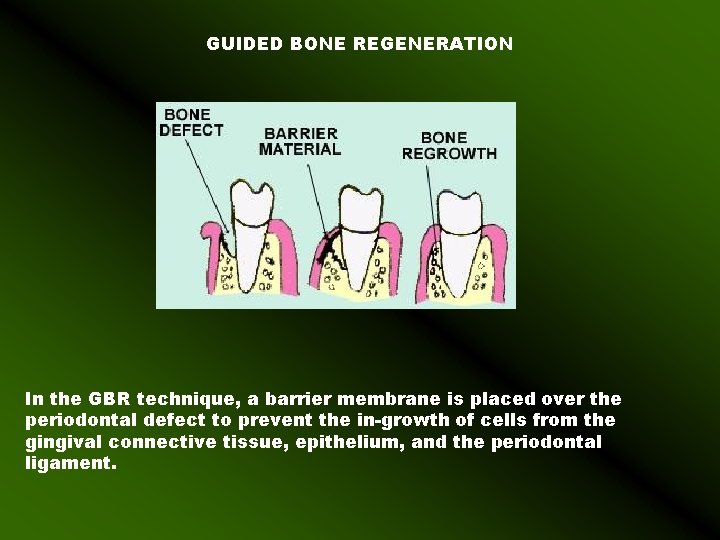 GUIDED BONE REGENERATION In the GBR technique, a barrier membrane is placed over the