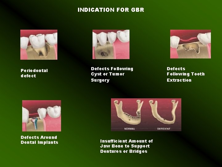 INDICATION FOR GBR Periodontal defect Defects Around Dental Implants Defects Following Cyst or Tumor