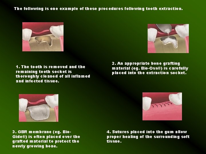 The following is one example of these procedures following tooth extraction. 1. The tooth