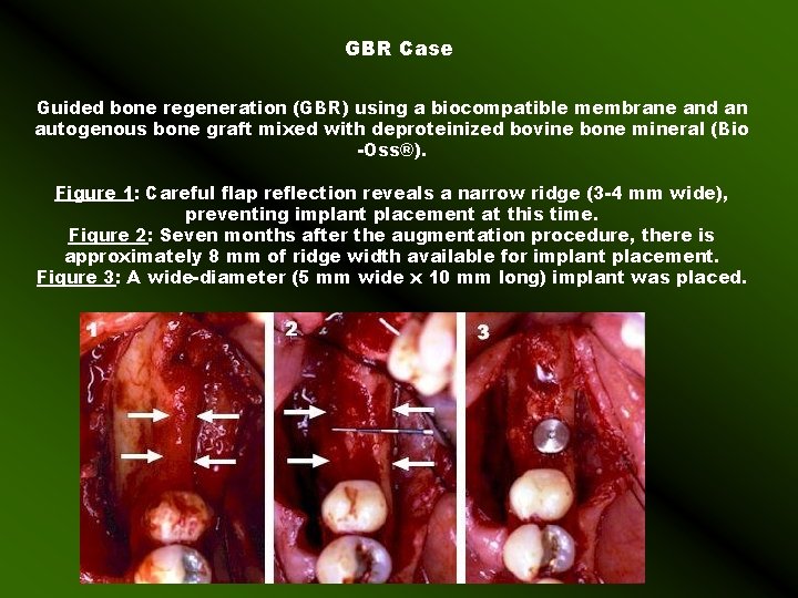 GBR Case Guided bone regeneration (GBR) using a biocompatible membrane and an autogenous bone