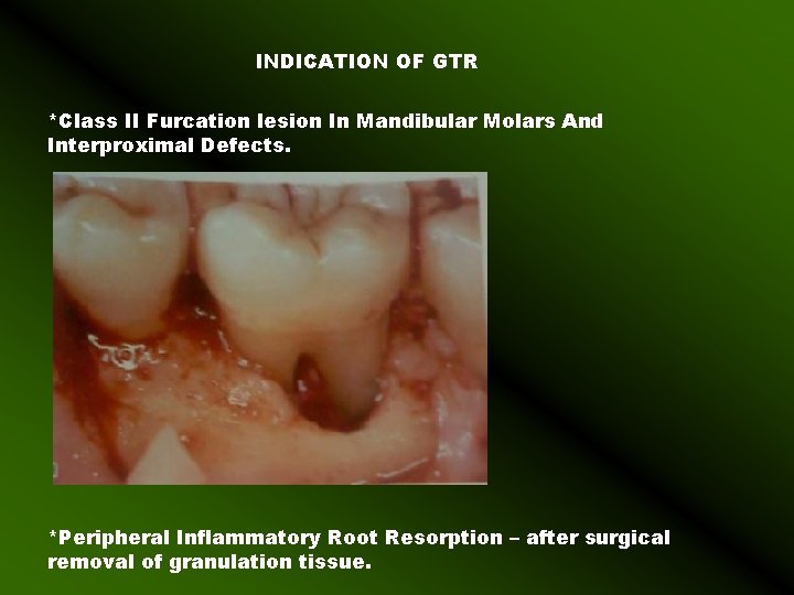 INDICATION OF GTR *Class II Furcation lesion In Mandibular Molars And Interproximal Defects. *Peripheral